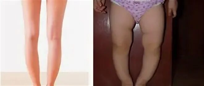 Варусные голени у детей