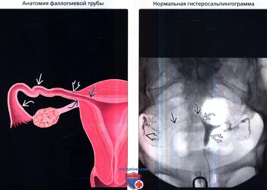 Фаллопиевы трубы это. Реканализация фаллопиевой трубы. реканализации маточных труб.. строение маточной трубы. интерстициальный отдел маточной трубы.