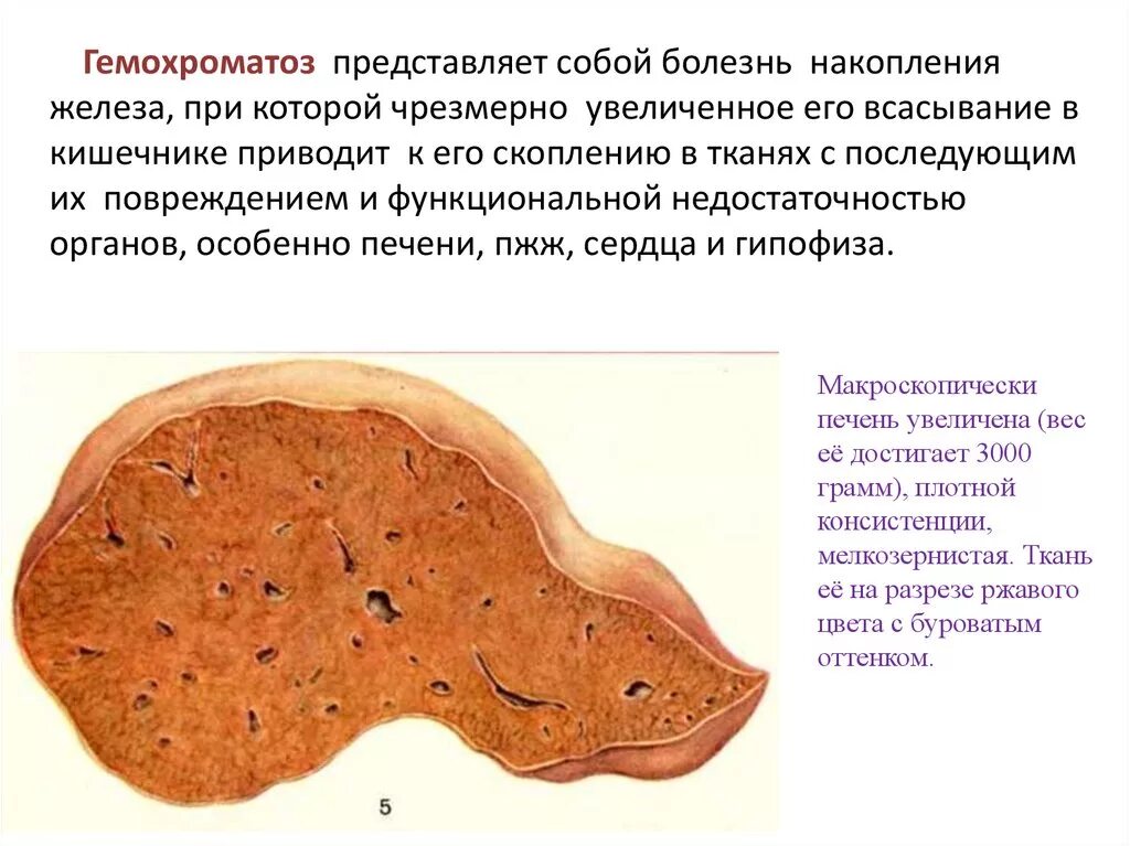 Гемохроматоз печени патологическая анатомия. Наследственный гемохроматоз печень. Макропрепарат болезни печени. Бронзовая кожа гемохроматоз. Повышен железа печень