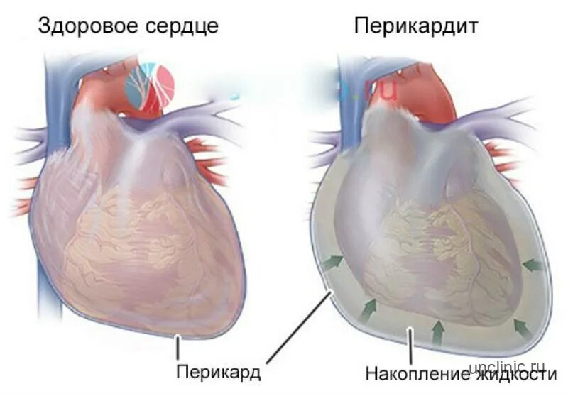 Скопление воздуха и крови в перикарде. Гидроперикард тампонада сердца. Перикардит гидроперикардит. Перикардит и тампонада сердца. Перикардит расхождение листков перикарда.