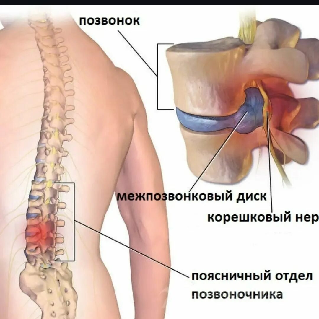 Из за чего грыжа на спине. Из за чего грыжа на спине
