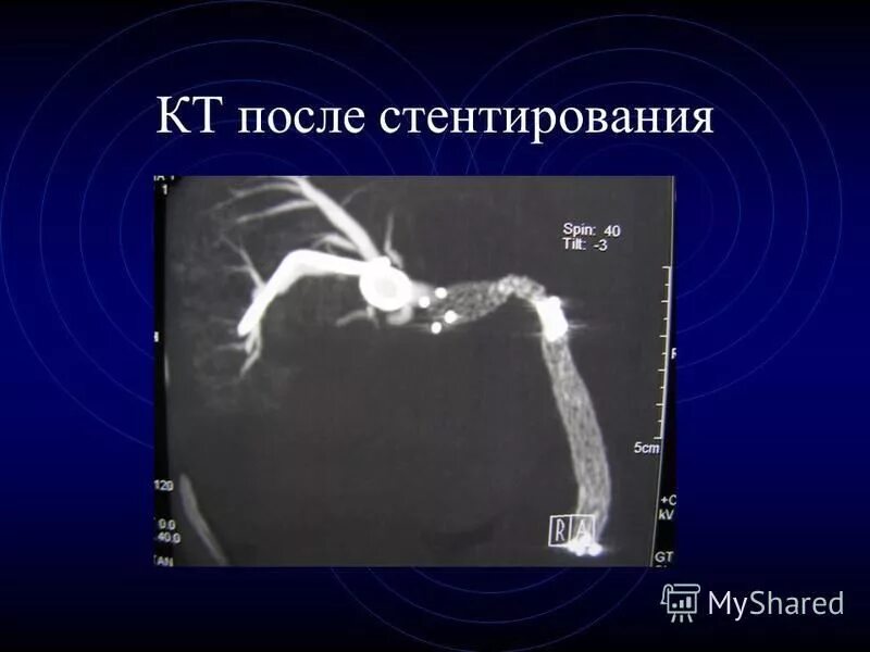 Стентирование коронарных артерий схема. Чрескожная баллонная ангиопластика. Коронарография анатомия. Коронарные сосуды коронарография. Коронароангиография стентирование.