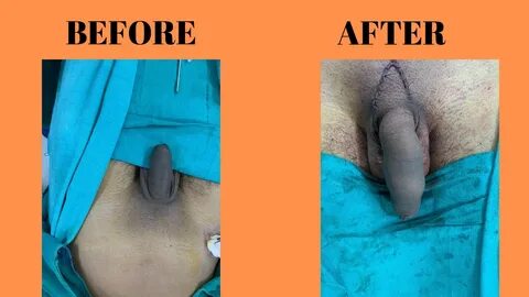 Penis Lengthening and Penis enlargement surgery cost in India