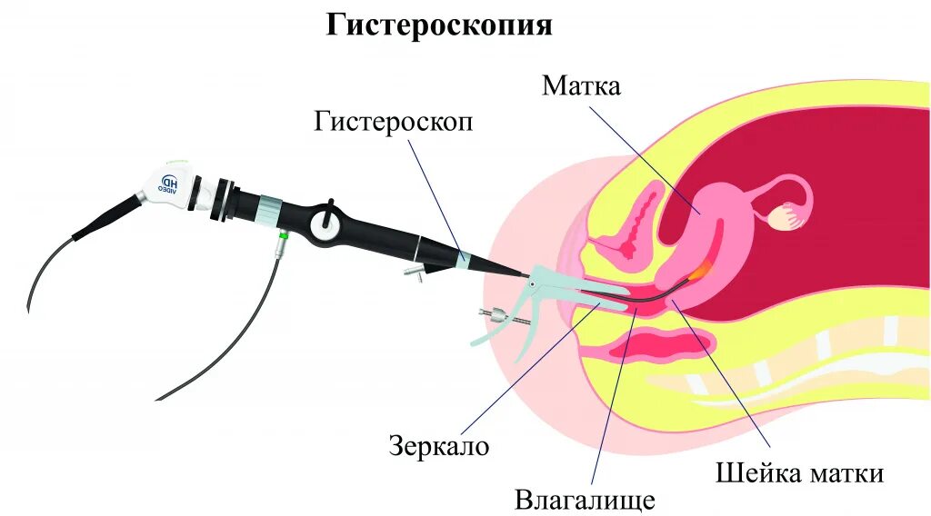 Сколько длится удаление полипов в матке. Гистерорезектоскопия (резектоскопия). Гистероскопическая миомэктомия. Гистероскопия ход операции. Миома матки гистероскопия.