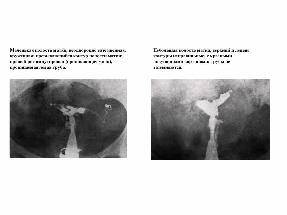 2 полости матки. Рентгенологические методы обследования в гинекологии. Рентгенологический метод исследования в гинекологии. Неоднородная полость матки.