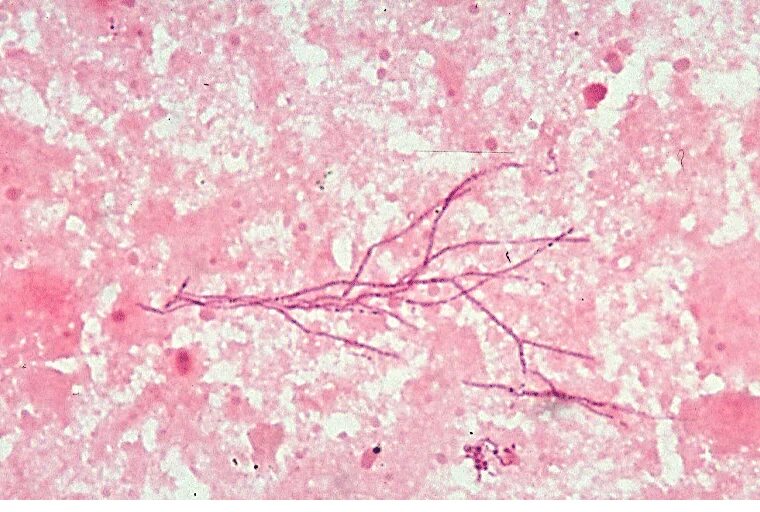 Микроскопия легкого. Слабая лейкоцитарная инфильтрация что это. Эмфизема лёгких гистология. Актиномикоз мокрота друзы. Дыхательная бронхиола гистология.