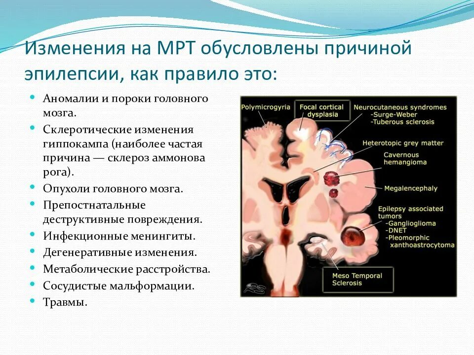 Причины структурной эпилепсии. Мрт головного мозга эпилепсия. Эпилепсия на мрт заключение. Кт признаки эпилепсии. Структурные изменения мозга