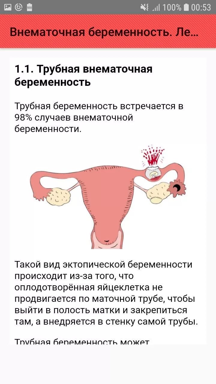 Почему происходит внематочная. Внематочная (эктопическая) беременность. Формы внематочной беременности. Внематочнаябкременность. Если внематочная беременность.