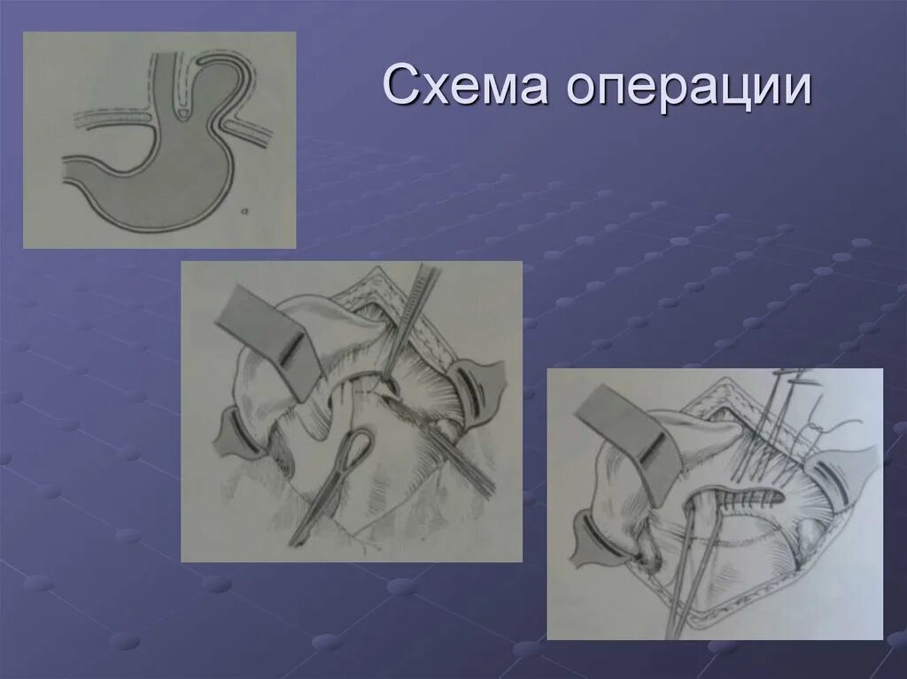 Операции на пищеводе. Операция грыжи пищеводного отверстия. Грыжа диафрагмы операция. Диафрагмальная грыжа опера. Грыжа пищевода операция.