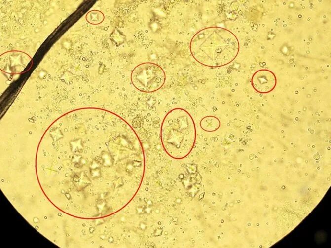 Повышены оксалаты кальция в моче. Оксалаты микроскопия мочи. Микроскопия осадка мочи оксалаты. Оксалаты кальция в моче. Оксалаты кальция в моче микроскопия.