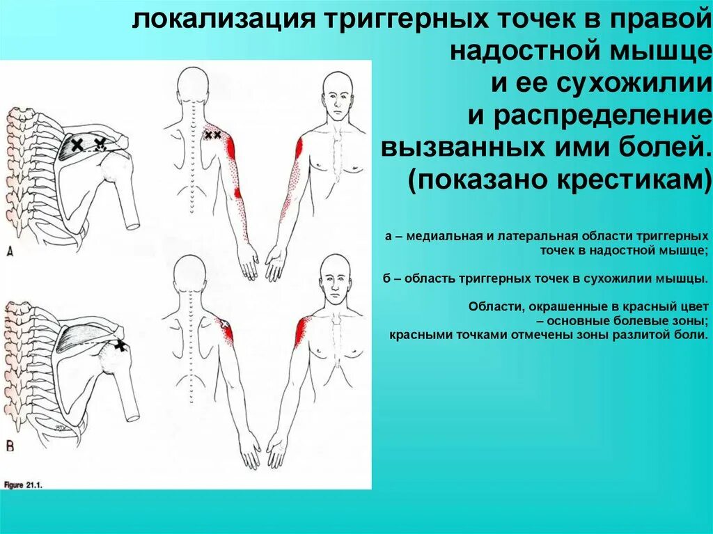 Боль в правом плече мышцы