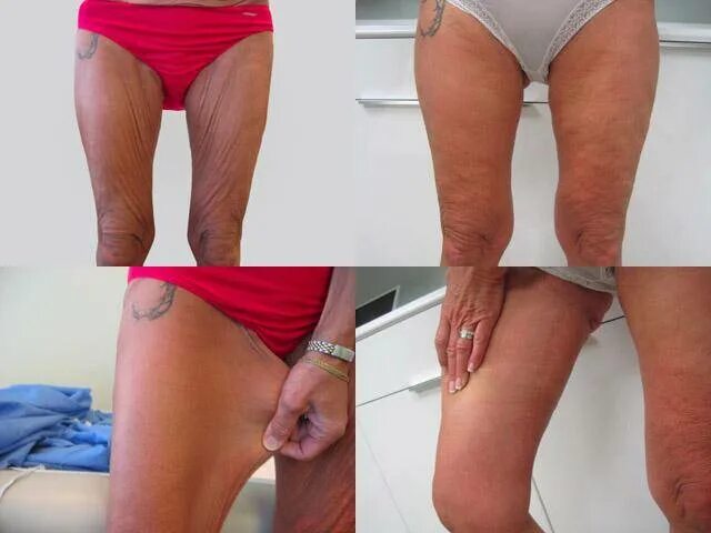 внутренняя поверхность бедра. лазерная липосакция галифе. подтяжка внутренней части бедра. внутренняя поверхность бедра кожа. жир на бедрах.