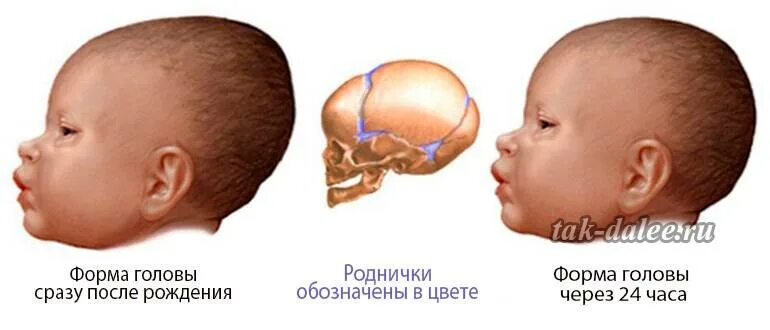 Какой должен быть родничок. Форма головы у новорожденных норма в месяц. Нормы головного черепа у грудничка. Долихоцефалическая форма головы новорожденного. Форма головы новорожденного Родничок.
