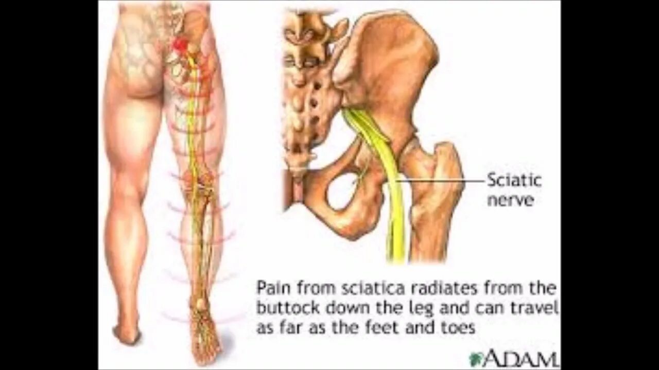 Защемило поясницу отдает в ногу