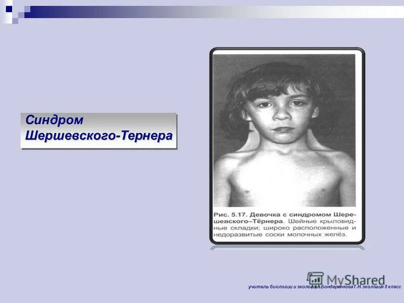 синдром мея тернера у женщин