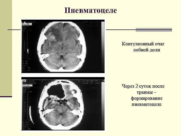 Единичный сосудистый очаг в лобной доле. Классификация контузионных очагов на кт. Контузионные очаги головного мозга. Контузионный очаг в головном мозге на кт. Очаг в лобной доли.