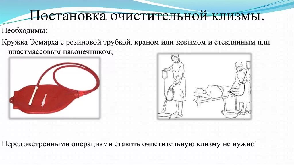 Постановка очистительной клизмы алгоритм. Техника постановки очистительной клизмы. Очистительная клизма алгоритм выполнения. Алгоритм проведения постановки очистительной клизмы.