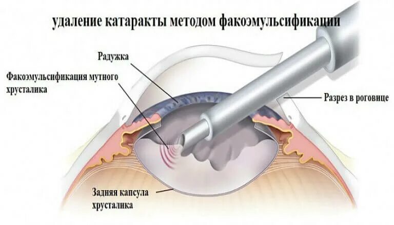 Замена хрусталика глаза как проходит операция. Интракапсулярная экстракция катаракты. Ультразвуковая факоэмульсификация катаракты ход операции. Интракапсулярная экстракция катаракты техника. Факоэмульсификация катаракты этапы операции.