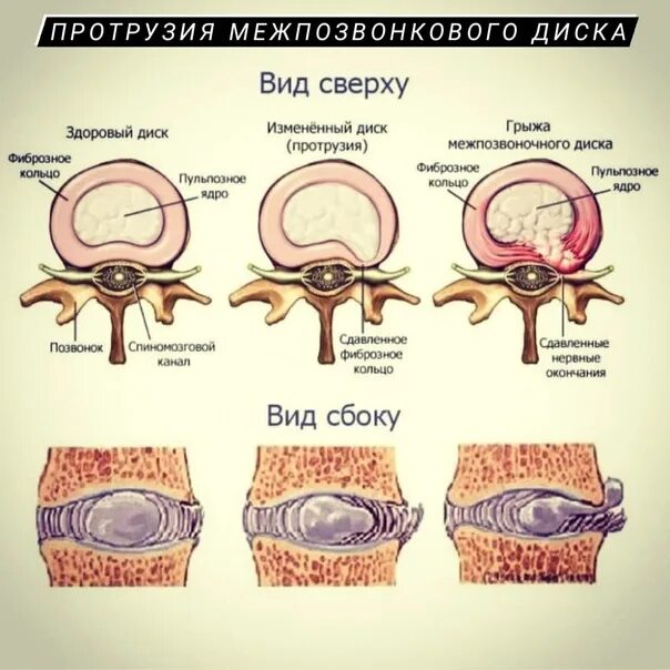Протрузии дисков позвоночника. Протрузия дисков позвоночника что это такое. Пултрузия. Виды протрузий межпозвонковых дисков. Экструзия дисков шейного отдела позвоночника