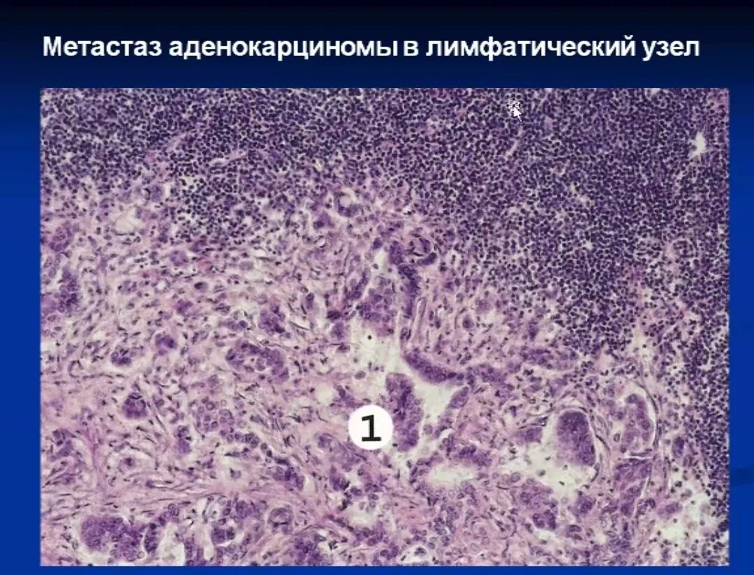 Метастазированные лимфоузлы. Метастаз аденокарциномы в лимфатический узел. Метастазы аденокарциномы в лимфоузлах. Аденокарцинома лимфатического узла. Аденокарцинома желудка g1.