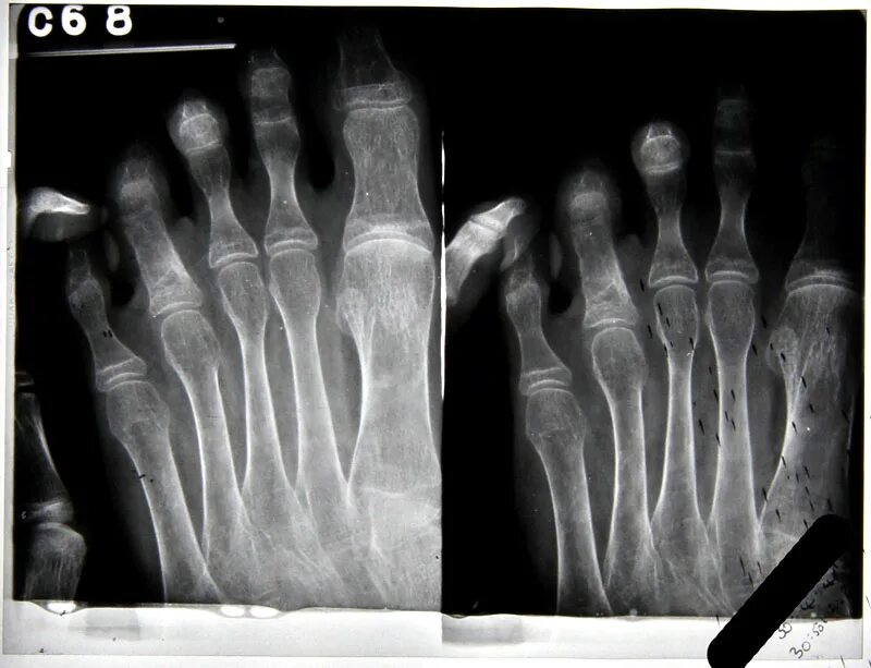 Ногтевая фаланга стопы. Остеомиелит фаланг стопы рентген. Остеомиелит кисти рентген. Остеомиелит ногтевой фаланги рентген. Остеомиелит фаланги пальца рентген.