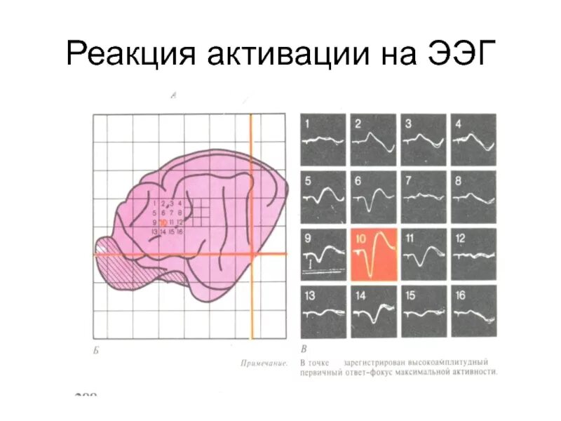 Реакция ээг. Реакция активации ЭЭГ. ЭЭГ реакция активации выражена. Реакция активации выражена на ЭЭГ что это значит. Реакция активации на ЭЭГ снижена.