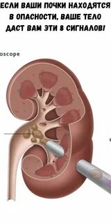 Камень в почках застрял в мочеточнике