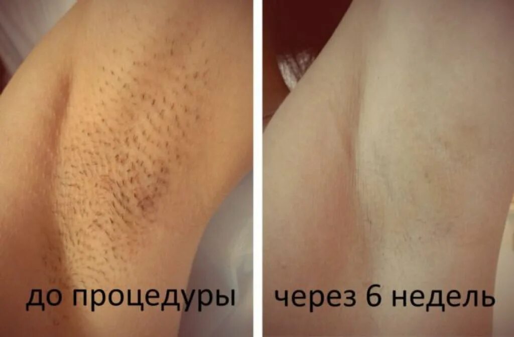 Лазерная эпиляция волосы выпадают через. Лазерная эпиляция. лазерная эпиляция волос. лазерная депиляция зоны бикини.