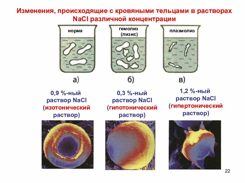 Эритроцит в различных концентрациях раствора. Гемолиз в гипотоническом растворе. гемолиз и плазмолиз эритроцитов. гипертонический раствор плазмолиз. гипотонический гемолиз.