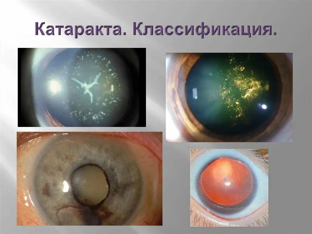 Стадии развития возрастной катаракты. Стадии катаракты глаза. Корковая катаракта стадии. Заднекапсульная катаракта. Сенильная катаракта стадии.