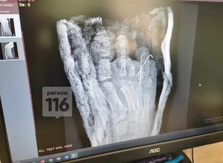 Мальчику оторвало 3 пальца