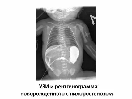 Пилороспазм у новорожденных