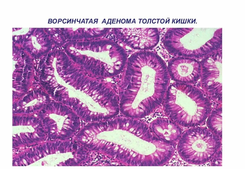 Аденокарцинома толстой кишки гистология. Аденома толстой кишки гистология. Полип толстой кишки микропрепарат. Ворсинчатая аденома толстой кишки микропрепарат. Ворсинчатая аденома толстой кишки микропрепарат.