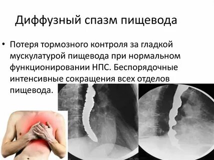 Спазм пищевода симптомы