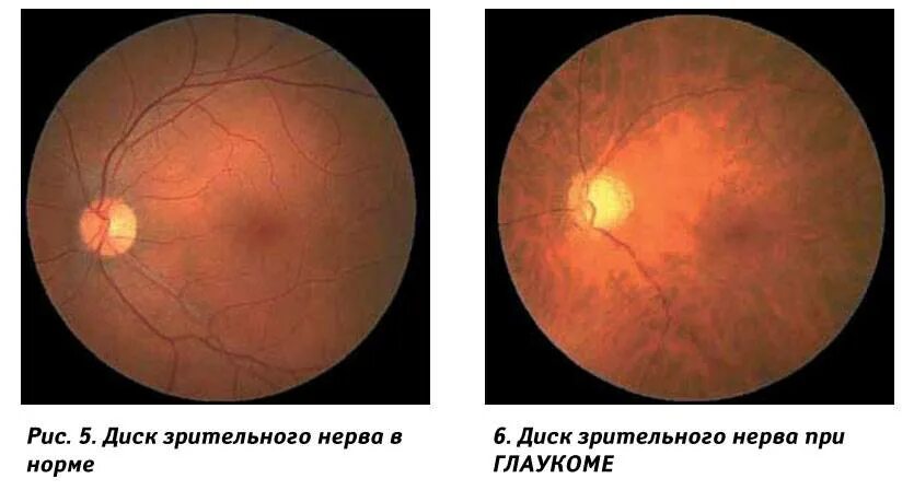 Норма зрительного нерва. Экскавация зрительного нерва норма. Глаукомная атрофия зрительного нерва. Нейропатия зрительного нерва Лебера.
