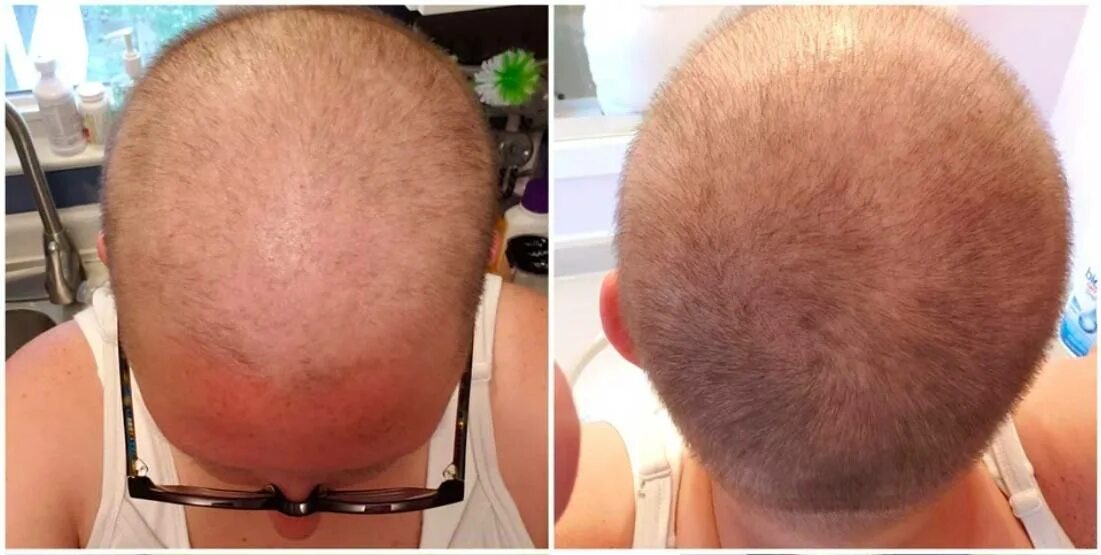 Очаговая алопеция (alopecia areata). Надпочечниковый гирсутизм. Начали расти волосы. Андрогензависимая алопеция. Начали расти волосы.