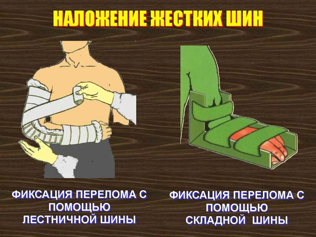 Наложение шины при переломе. Наложение шины. правильное наложение шины. методика наложения шин. шина для иммобилизации поврежденной.