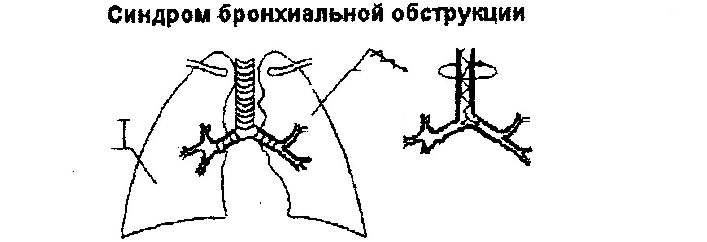 Бронхиальное раздражение