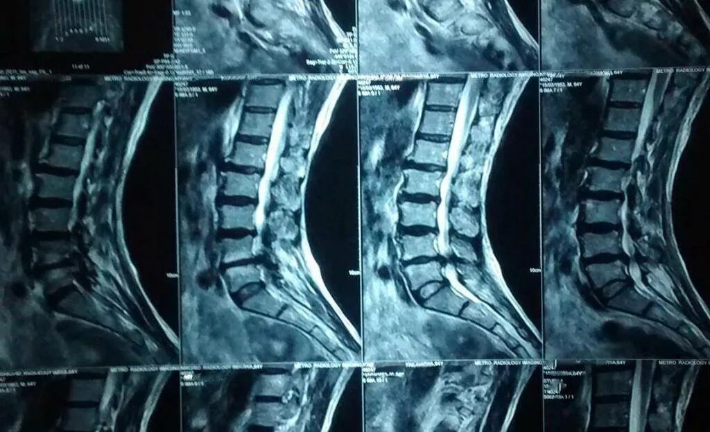 Протрузия межпозвоночного диска поясничного. Протрузия l5 l6. Протрузия с5-с6. Протрузия дисков позвоночника что это такое. Грыжа Шморля рентген.