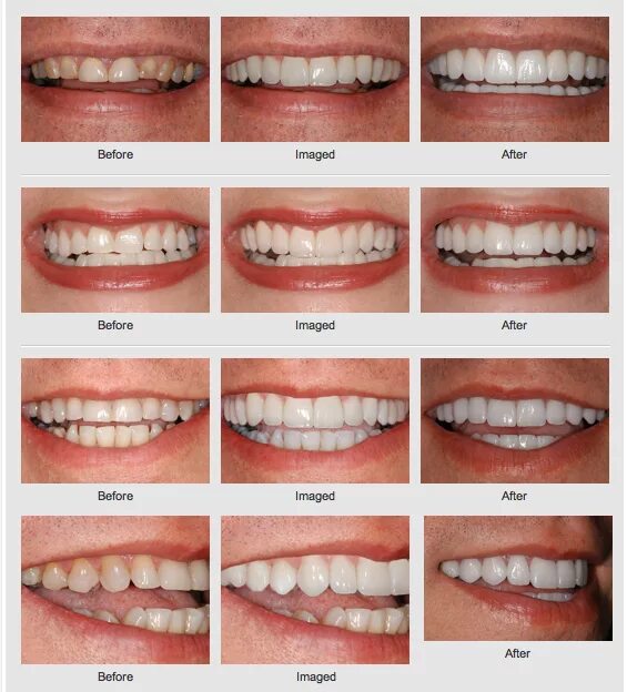 Like before. Форма зубов. Формы зубов человека. Типы формы зубов. Прямоугольная форма зубов.