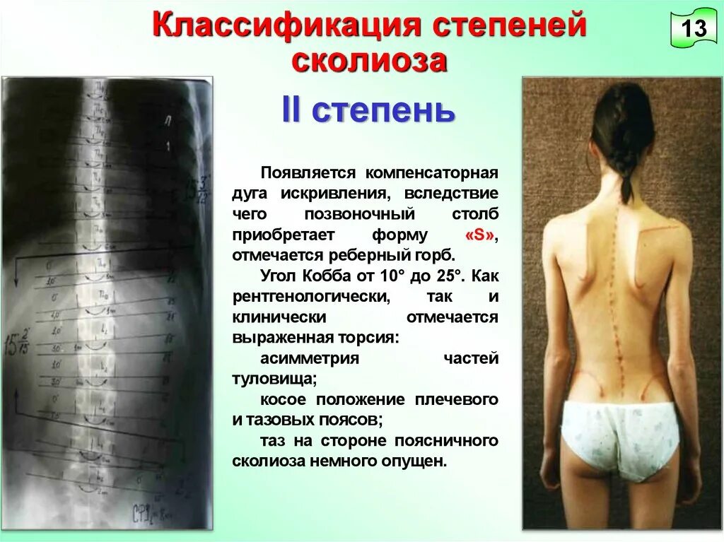 сколиоз позвоночника степени в градусах. S образный сколиоз позвоночника 2 степени. сколиоз 3 степени диагноз. сколиотическая деформация. угол кобба степени сколиоза.