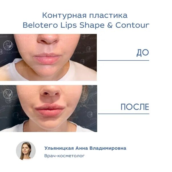 Belotero shape отзывы. Контурная пластика Белотеро Липс Шейп. Контурная пластика губ Белотеро. Белотеро софт для губ. Препарат Белотеро Липс.