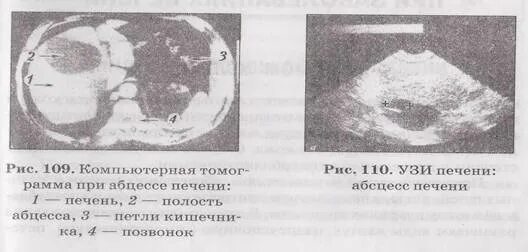 Печень по краю реберной дуги. Печень выступает из под края реберной дуги. Печень не пальпируется. Печень пальпируется по краю реберной дуги. Пальпируется край печени.