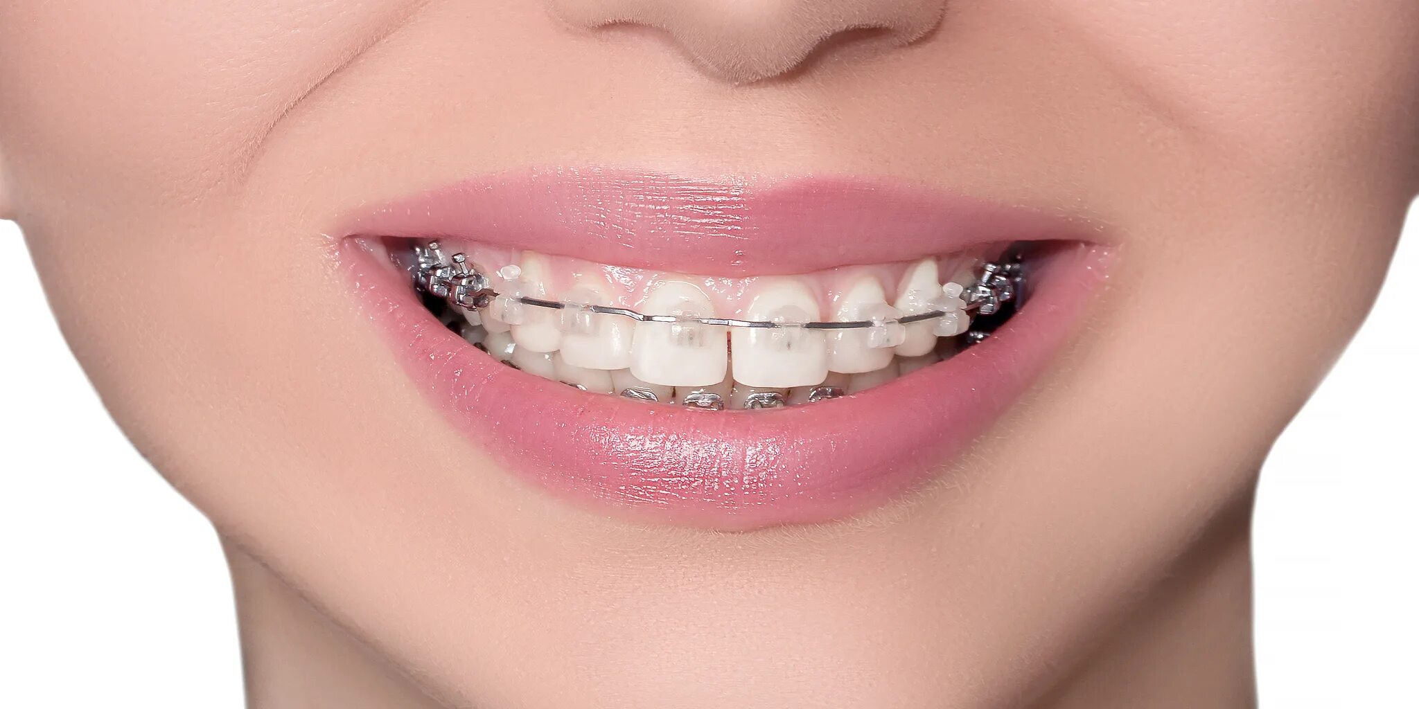 Brackets photo. Brackets photo