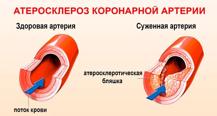 Ишемическая болезнь сосудов. Атеросклероз венечных сосудов сердца симптомы. Атеросклеротическое поражение коронарных артерий. ИБС атеросклероз коронарных артерий. Симптомы атеросклероза коронарных артерий сердца.