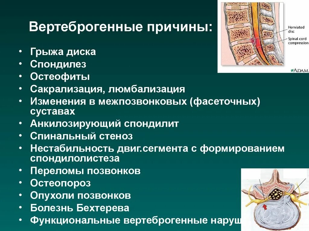 Поражение нервов причины. Вертеброгенные заболевания. Вертеброгенные заболевания нервной системы. Вертеброгенные заболевания периферической нервной системы. Вертеброгенных неврологических расстройств.