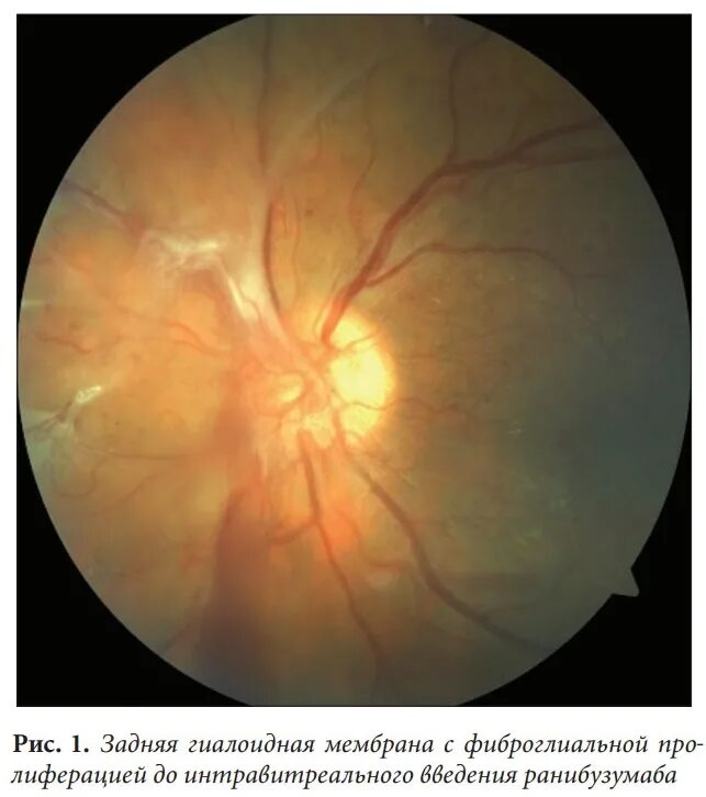 Эпиретинальный фиброз глаза. Эпиретинальная мембрана сетчатки. Пролиферативная витреоретинопатия. Эпиретинальная мембрана на окт. Эпиретинальный фиброз.