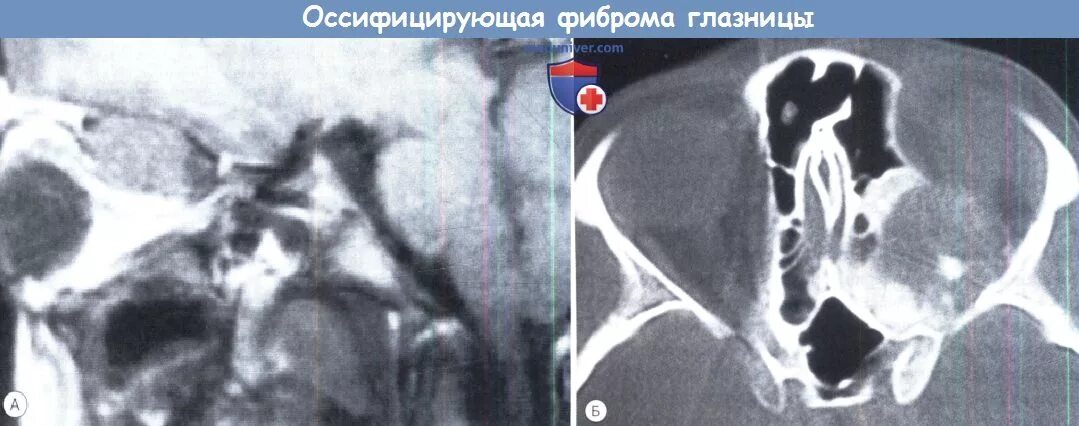 Фиброма кт. Оссифицирующая фиброма кт. оссифицирующая фиброма верхнечелюстной пазухи. оссифицирующая фиброма нижней челюсти. оссифицирующая фиброма лобной пазухи.