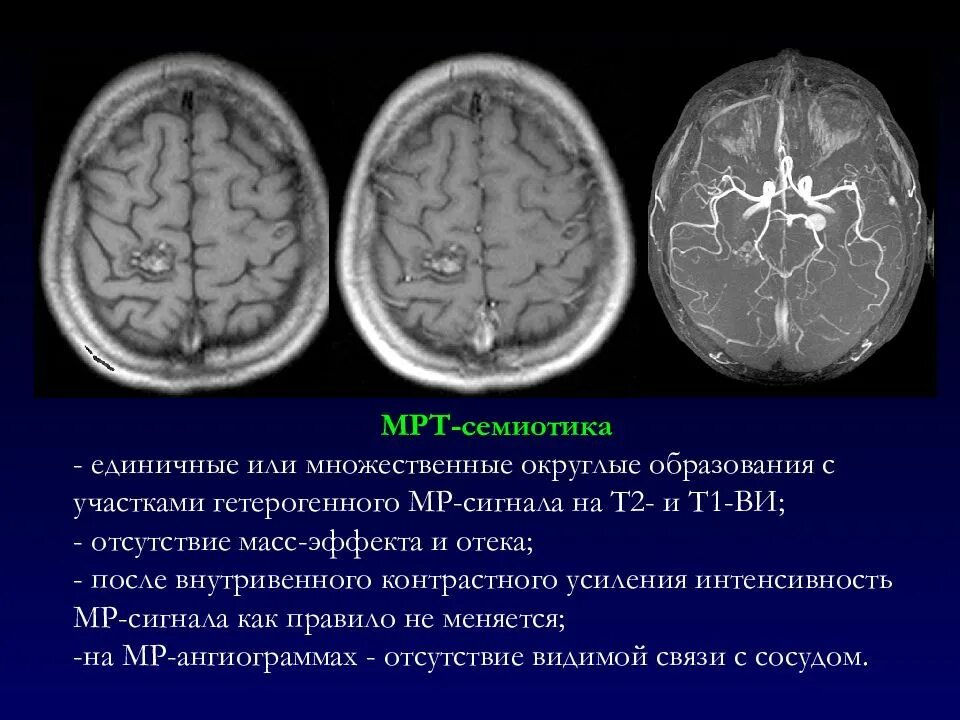 Множественные округлые. МР-сигнал на т2 ви что это. Т1 и т2 мрт. Мрт головного мозга т1 и т2. Сигналы мрт т1 и т2.