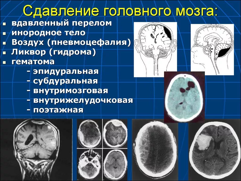 Инфратенториальная субдуральная гематома. Сдавление головного мозга. Давление головного мозга. Сдавление головного мозга внутричерепными гематомами.